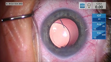 Dislocated Sulcus IOL: Repositioning with Optic Capture Configuration