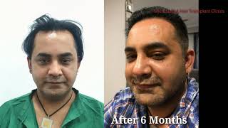 Client From New Zealand Hair Transplant Before And After Microsurg-4 Hair Transplant Clinics,India
