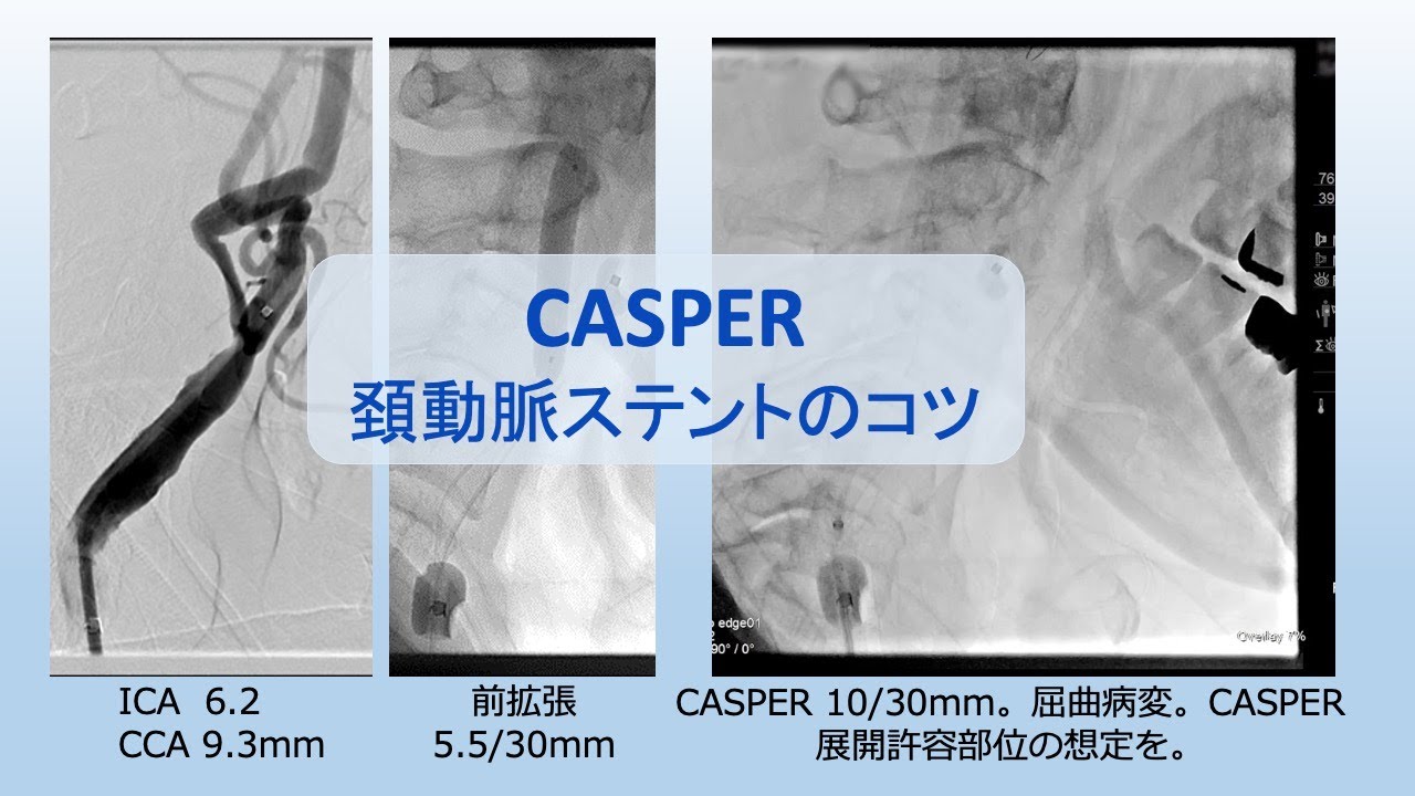 CASPER 頚動脈ステント留置（CAS）のコツ