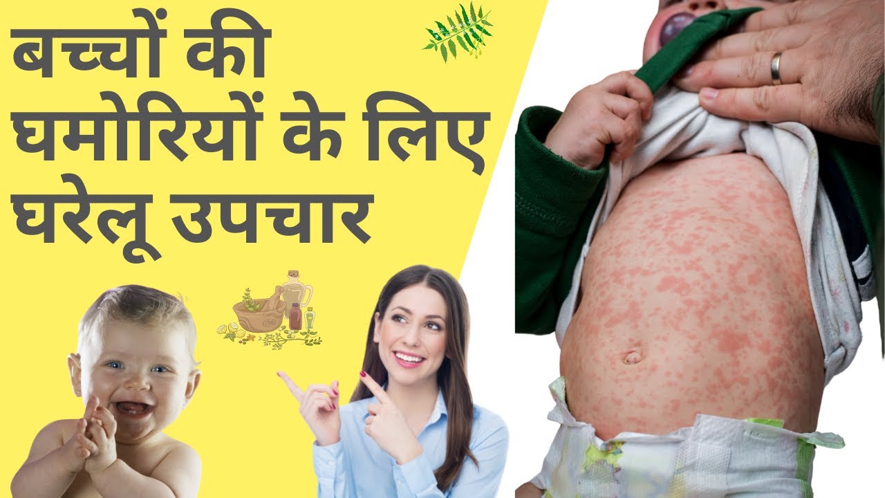 7 Home Remedies for Prickly Heat Rashes in Kids How to treat prickly