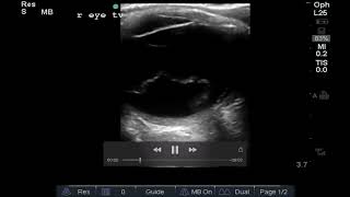 Ultrasonography Demonstrating Retinal Detachment