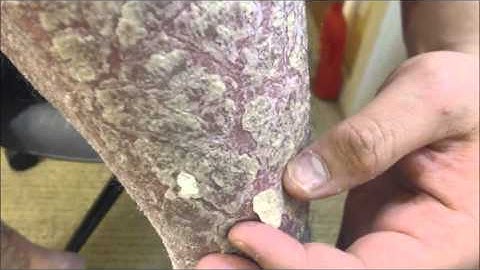 Frosted Skin Flakes - [Psoriasis, Peel, Scrape]