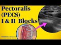 Pectoralis (PECS) blocks I & II