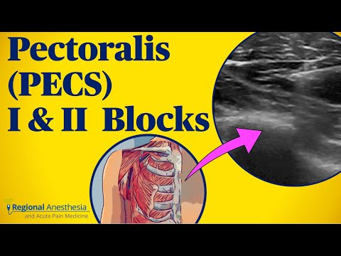 Pectoralis (PECS) blocks I & II