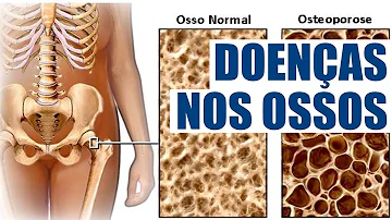 O que causa o enfraquecimento dos ossos?