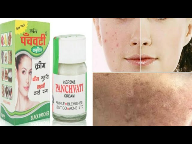 panchvati pimple cream