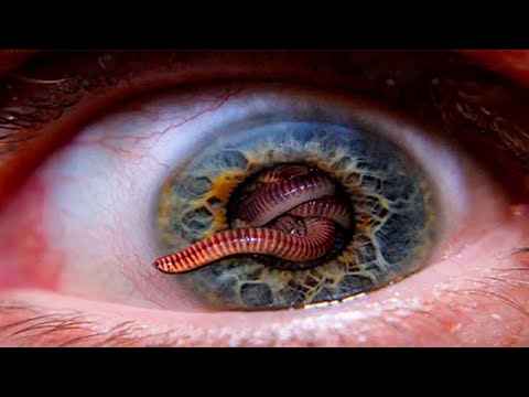 Видео: Как понять, есть ли у вас паразиты?