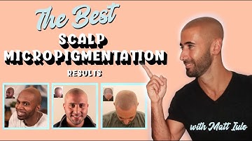 Best Scalp Micropigmentation Results 2020