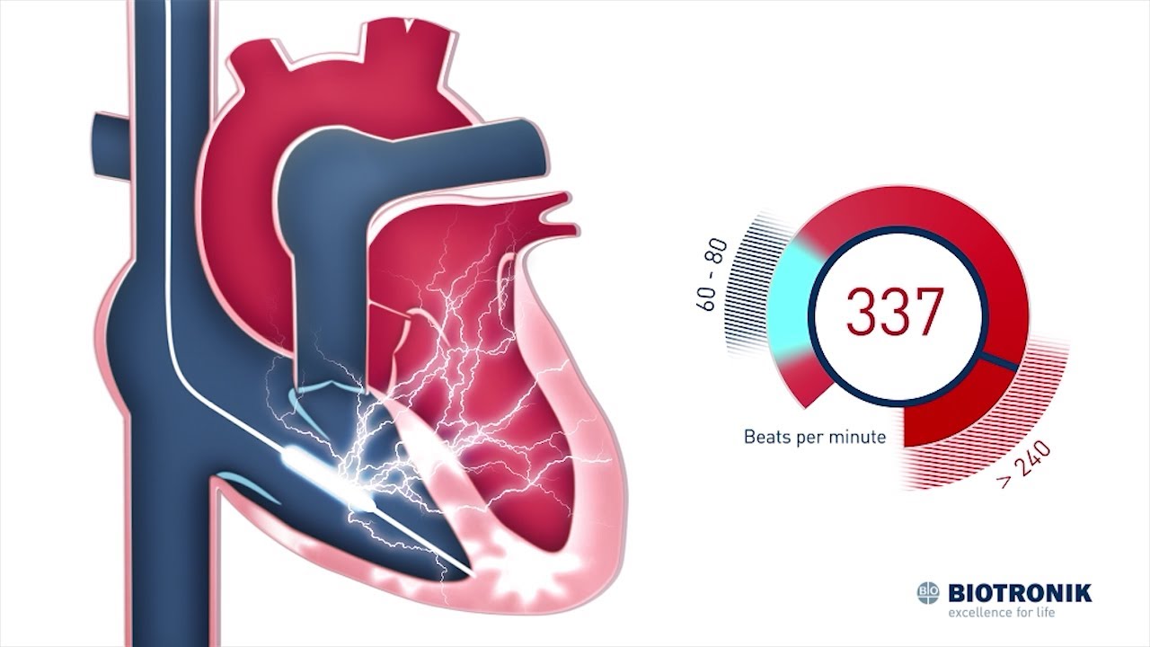 d-fibrillateur-cardioverteur-implantable-comment-il-fonctionne-youtube
