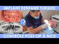 Implant dentaire Turquie - Suivi dentiste à Nice