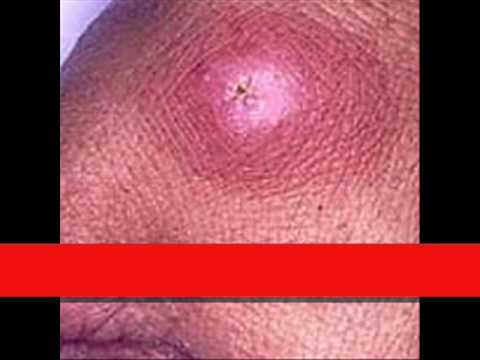 surviving mrsa graphic images true story youtube mercer illness