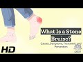 Stone Bruises Unveiled: Causes, Symptoms, and Solutions