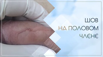 👦 Шов на половом члене. Клинический случай №39