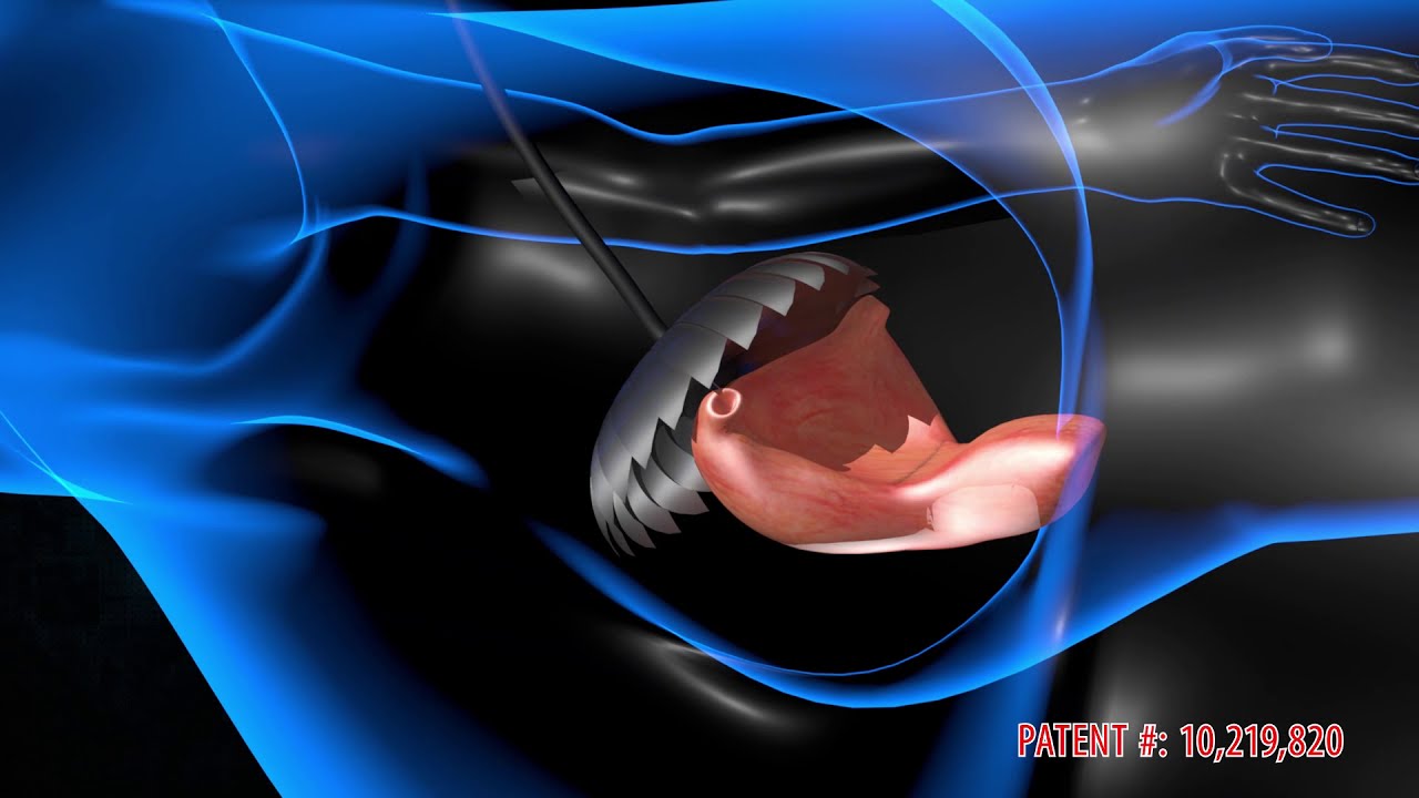 DeVille 3D Medical Animation | Surgical Compactor & Extractor | 3D Medical Graphics by Industrial3D