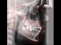 ROTATION of occlusal plane