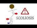 Right Scoliosis - Stretch exercise to reduce a right scoliosis