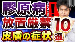 膠原病の皮膚症状を徹底解説！皮膚症状で早期発見を！膠原病皮膚症状