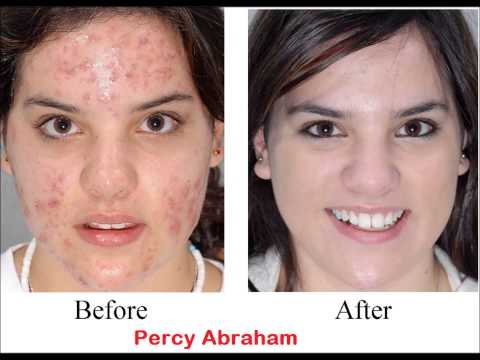 Permanent Solution to Acne - Get Rid of Acne Forever