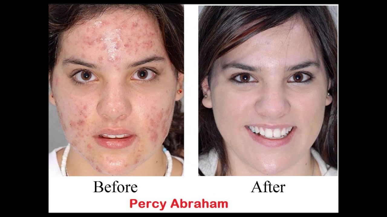 how to get rid of acne completely