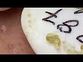 blackhead removal from nose/ old aged blackheads removal