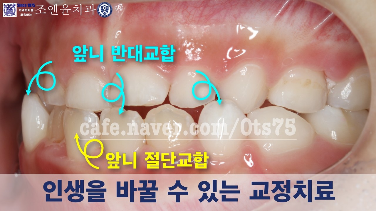 [내일남] 앞니 절단교합 / 앞니 반대교합을 방치하면 벌어지는 아이들의 위험함 미래 : 예방교정치료 (소아교정치료) 에서 치료교정치료 (성인교정치료) 로 인생을 바꿀 수 있습니다