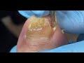 Nails become brittle due to fungus