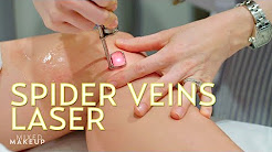 We Tried a Spider Veins Laser Treatment! | The SASS with Susan and Sharzad