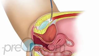 Mesh Sling for Stress Urinary Incontinence • PreOp Patient Education