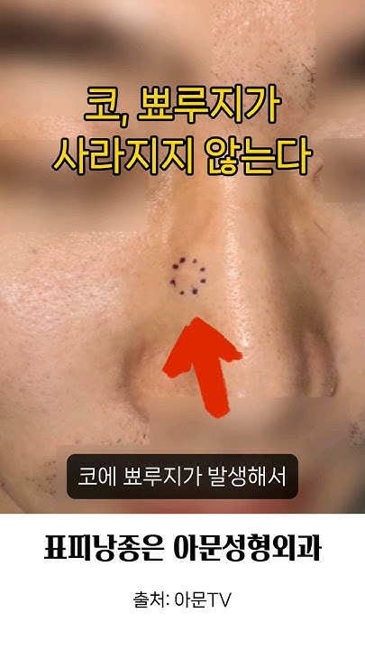 코 뾰루지가 사라지지 않는다 ?(핀홀법 수술 피지낭종 표피낭종 피부과 성형외과 병원 흉터 Epidermal Cyst ...