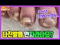 3년전에 다친발톱이 아직도?? 발톱이 안 자라는걸까요? #레푸스쌍용점 #천안발톱무좀 #천안무좀발톱 #athletesfoot