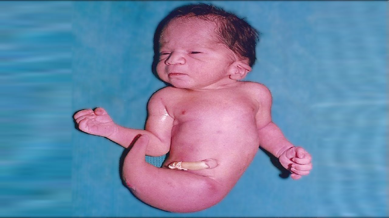 Baby diagnosed with 'mermaid syndrome' dies minutes after birth