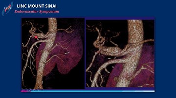 Complex Aortic Case Presentations