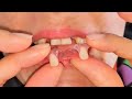 How to remove the palate from a dental prosthesis