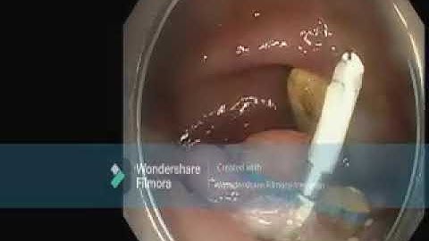 Dynamic Traction Using Loop and Clip Technique in ESD 