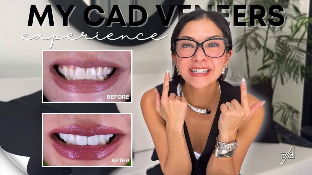 Transforming My Smile: The Veneer Makeover Journey