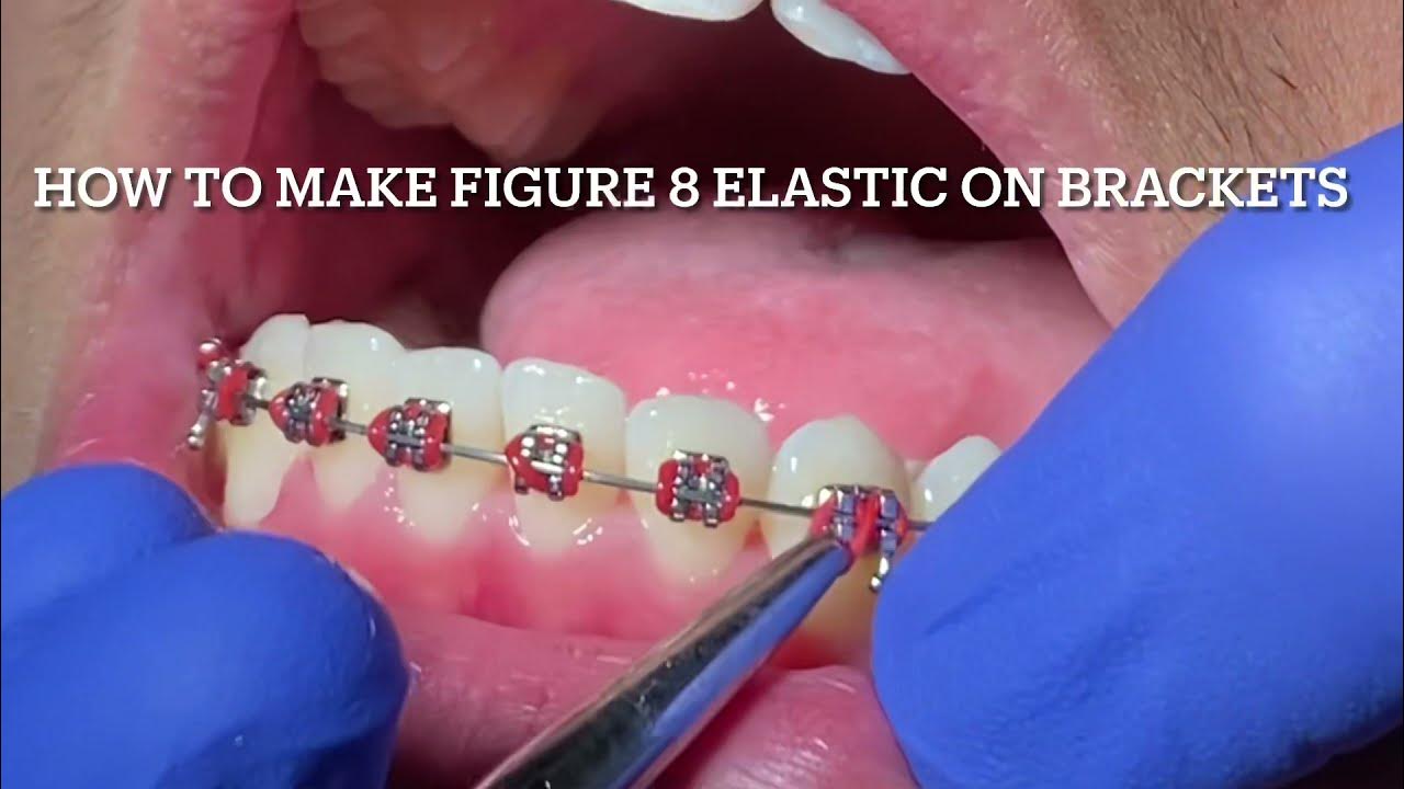 How to place elastic power chain and elastics on ortho brackets YouTube