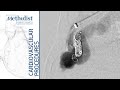 Pulmonary Arteriovenous Malformation Coil Embolization & Plug Placement (Lumsden, MD; Zubair, MD)