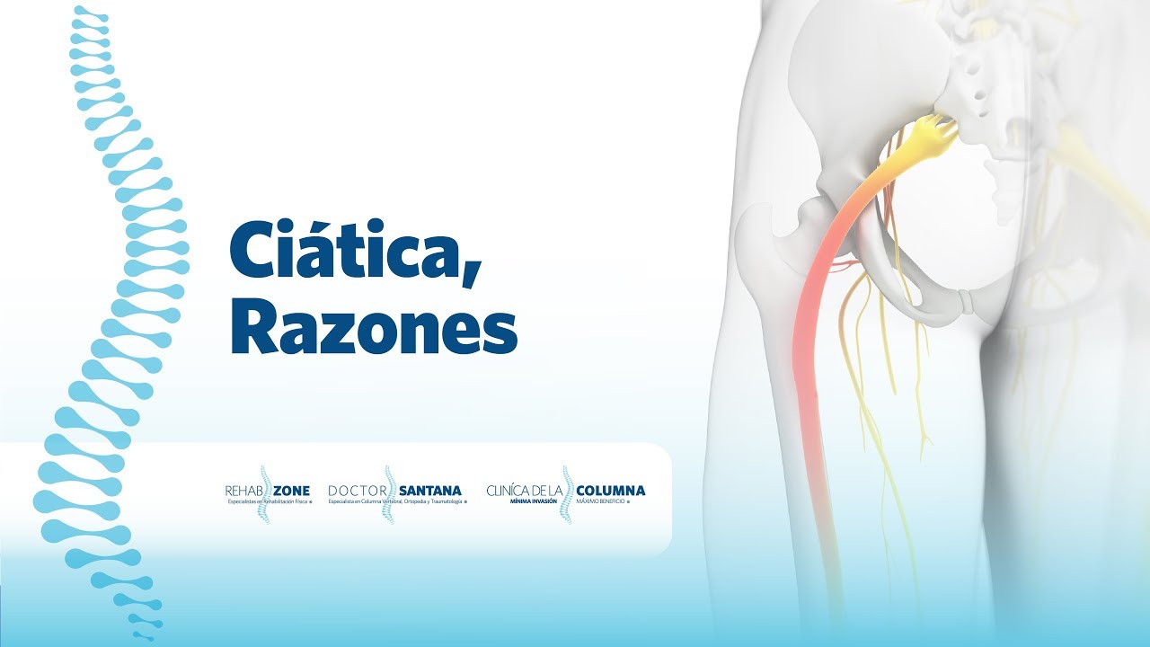 tampa El Dr. Miguel Ángel Santana habla sobre: Ciática, Razones