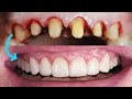 Front tooth crowns before  after cosmetic dentist smile makeover emax preparation remove veneers