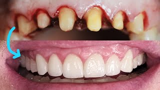 Front Tooth Crowns Before & After! Cosmetic Dentist Smile Makeover EMAX Preparation, Remove Veneers