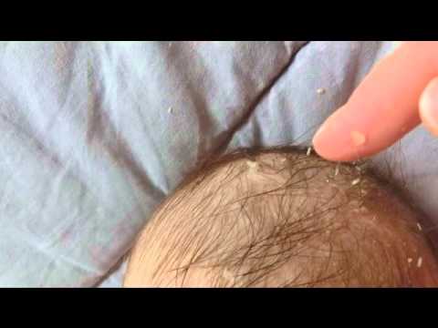 Kopfgneis Hautschuppen beim Baby entfernen