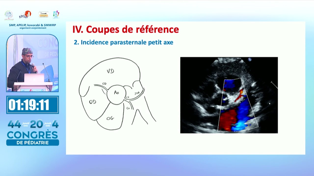 APELIP SMP 2025 : Atelier : Échocardiographie néonatale et pédiatrique  N. Slitine, A.Ayad