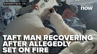 Man allegedly set on fire in Taft faces long recovery