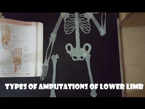 Types of lower limb amputation