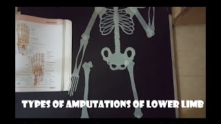 Types of lower limb amputation