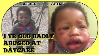 1 YR OLD ABUSED AT DAYCARE