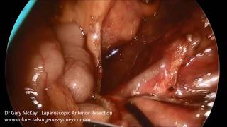 Laparoscopic Anterior Resection - Korean