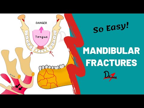 Mandibular Fractures | Basics | DENTAL NOTES