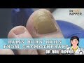 Ram's Horn Nails From Chemotherapy - Dr Nail Nipper