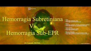 Hemorragia Subretiniana Vs Hemorragia sub-Epitelio Pigmentario de la Retina. Diferencias.
